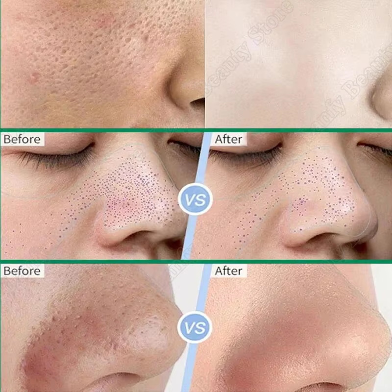 살리실산 모공 클리어링 크림 모공 축소 블랙헤드 제거  - Salicylic Acid Blackhead Remover 리뷰 및 가격